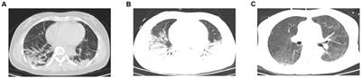 Case report: Inhaled nitric oxide rescued a hypoxemia patient caused by dermatomyositis complicated with interstitial pneumonia